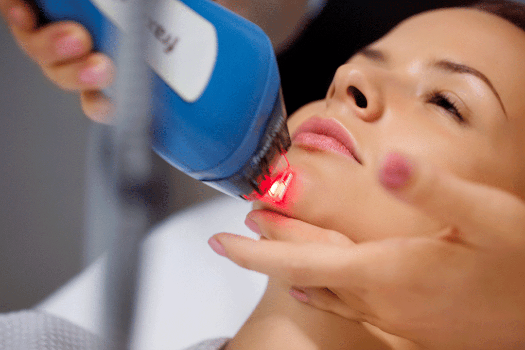 rejuvenecimiento de la piel facial con láser