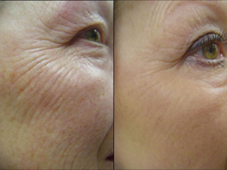 Antes y después del procedimiento de rejuvenecimiento con láser una reducción significativa de las arrugas