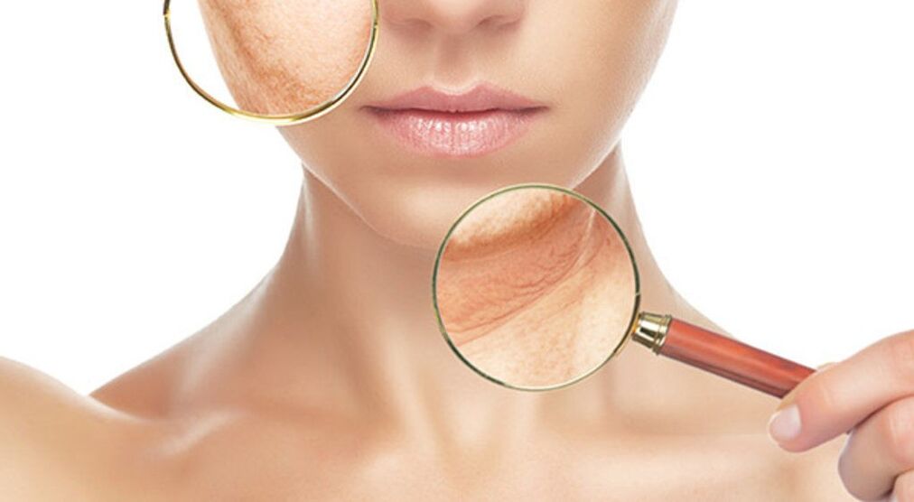 Las arrugas se pueden eliminar de manera efectiva con el tratamiento con láser. 