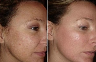 rejuvenecimiento de la piel facial con láser fotos antes y después